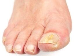 Nail filgus