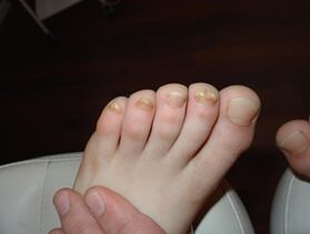 Onychoycosis