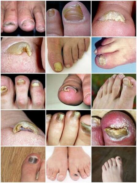 Pilzinfektioun vun der Zehennagelplack