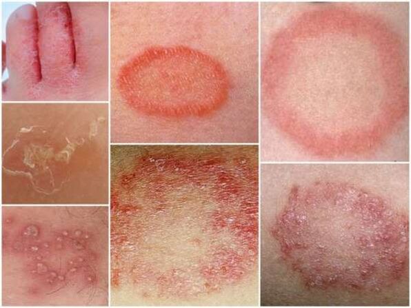 Trichophytose vun der Haut vun de Been