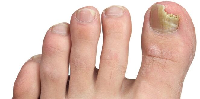 Pilzinfektioun vun der Nagelplack